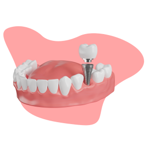 Dental implant