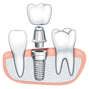 implant gigi