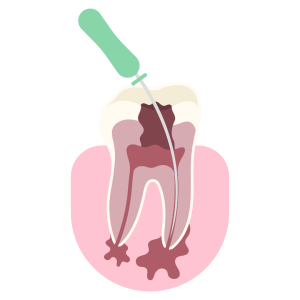 root canal treatment