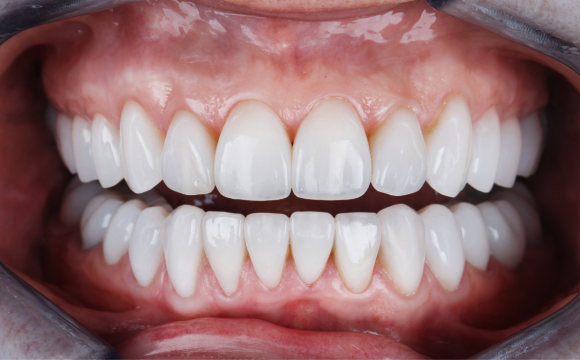 Porcelain Veneers