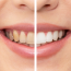 Tooth whitening